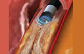 Large UK Study Explores Use of Excimer Laser Coronary Atherectomy 
