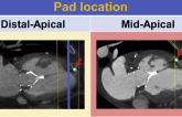 Implantation Technique Influences LV Remodeling After TMVR