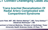 TCT 690: Transbrachial Recanalization of Radial Artery Complicated With Compartment Syndrome