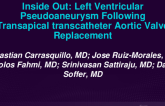 TCT 679: Inside Out: Left Ventricular Aneurysm Following Transcatheter Aortic Valve Replacement.