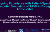 TCT 121: Ongoing Experience With Patient-Specific Computer Simulation of Transcatheter Aortic Valve Replacement in Bicuspid Aortic Valve