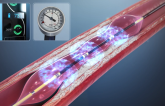 DISRUPT CAD III: Lithotripsy Boosts Stent Expansion in Highly Calcified Lesions
