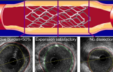 IVUS-Guided PCI Gains Support With Longer-Term ULTIMATE Results