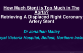 TCT 546: Too Much Stent In The Aorta? Retrieving A Displaced Coronary Artery Stent
