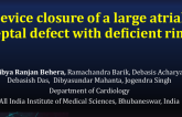 TCT 623: Device Closure of a Large Atrial Septal Defect With Deficient Rim