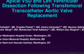 TCT 612: Apical VSD and Left Ventricular Dissection Following Transfemoral Transcatheter Aortic Valve Replacement