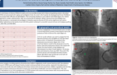 TCT 638: Successful Revascularization with Intracoronary Alteplase: Acute Myocardial infarction of Severe Complex Aneurysmal Coronary Artery Disease