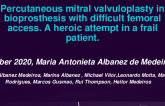 TCT 604: Percutaneous Mitral Valvuloplasty in Bioprosthesis With a Femoral Access Disease