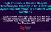 TCT 527: High Thrombus Burden Despite Thrombolytic Therapy in ST-Elevation Myocardial Infarction in a Patient With COVID-19