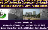 TCT 126: Outcomes of Patients With Severe Aortic Stenosis and Left Ventricular Obstruction Undergoing Transcatheter Aortic Valve Replacement