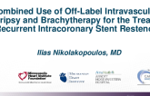TCT 550: Combined Use of Off-Label Intravascular Lithotripsy and Brachytherapy for the Treatment of Recurrent Intracoronary Stent Restenosis