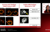 OCT and MRI Find an MI Cause in 85% of Women With MINOCA: HARP