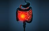 Increased ASCVD Risk With Inflammatory Bowel Disease Merits Team-Based Care