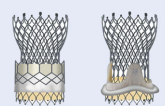 TAVR Yields Similar Success in Failed TAVR or Surgical Valves