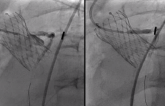 Unplanned PCI Rare After TAVI, but Operators Get Good Results