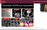 Assessing Myocardial Damage in COVID-19: The Role of CMR