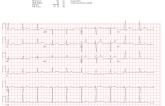 Machine Learning ‘Sniffs’ Out Long QT Otherwise Unseen on ECG 