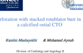 Perforation with stucked rotablator burr in a calcified ostial CTO  