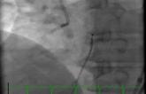 The Role of CTA in Modern Day CTO PCI — Case Examples