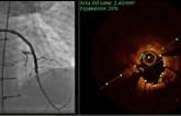 ‘Aggressive’ OCT Strategy for Stent Sizing Noninferior to IVUS: iSIGHT
