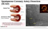 Diagnosis of SCAD on Coronary Angiography