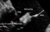 For Failed MitraClip, Next Procedure Might Depend on MR Etiology