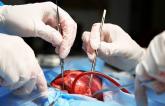 Occluding the LAA During Surgery Lowers Stroke Risk: LAAOS III