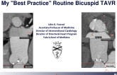 My "Best Practice’" Routine Bicuspid TAVR