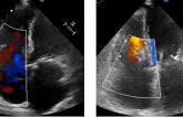 Pascal Device Works Well for Tricuspid Regurgitation in Commercial Market