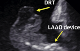 Predictors of Device-Related Thrombus Following LAA Occlusion