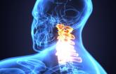 Spinal Cord Stimulation Reduces Post-CABG AF: Pilot Study
