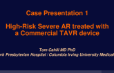 Case Presentation 1: High-Risk Severe AR with Commercially-Approved TAVR