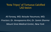 TCT 590: ‘Rota Tripsy’ of Tortuous Calcified LAD/D1 Bifurcation