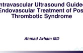 TCT 686: Intravascular Ultrasound Guided Endovascular Treatment of Post Thrombotic Syndrome