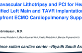 TCT 610: Intravascular Lithotripsy and Percutaneous Coronary Intervention for Heavily Calcified Left Main Stenosis and Transcatheter Aortic Valve Replacement Under Upfront Extracorporeal Membrane Oxygenation Cardiopulmonary Support