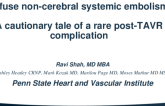 TCT 712: Diffuse Non-Cerebral Systemic Embolism: A Cautionary Tale of a Rare Post TAVR Complication