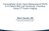 TCT 533: Transcatheter Aortic Valve Replacement(TAVR) In A Patient With Left Ventricular Thrombus Using CT Fusion Imaging