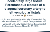 TCT 609: Percutaneous Closure of a Large Diagonal Coronary Artery to Left Ventricular Fistula