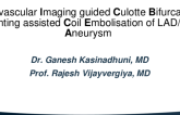 TCT 715: IVUS Guided Culotte Bifurcation Stenting Assisted Coil Embolisation Of LAD/D1 Bifurcation Aneurysm In A Patient With ANCA Positive Vasculitis