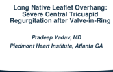 TCT 603: First Report: Long Native Leaflet Causing "Leaflet Overhang" Causing Severe Central Tricuspid Regurgitation After Valve-In-Ring With Sapien 3 Valve