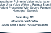 TCT 596: Transcatheter Pulmonic Valve Implantation of a Sapien Ultra Valve Within a Palmaz Stent in a Patient Presenting With Severe Pulmonic Homograft Stenosis
