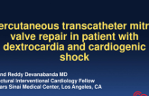 TCT 582: Percutaneous Transcatheter Mitral Valve Repair In Patient With Dextrocardia And Cardiogenic Shock