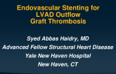 TCT 616: Endovascular Stenting for LVAD Outflow Tract Thrombosis