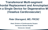 Transfemoral Multi-segment Chordal Replacement and Annuloplasty in a Single Device for Degenerative MR (Vesalius Cardiovascular)