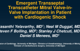 Emergent Transseptal Transcatheter Mitral Valve-in-Valve Implantation in Patient With Cardiogenic Shock