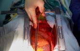 Using Donor Hearts After Circulatory Death Is Feasible for Transplantation 