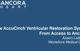 From Access to Anchors:  The AccuCinch Ventricular Restoration System