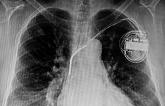 Most Infected Cardiac Implanted Electronic Devices Not Removed Fast Enough