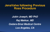 JenaValve to treat a degenerative regurgitant aortic valve following previous Ross procedure with no annular calcium. 