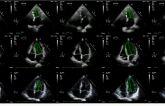 EchoNet AI Algorithm Beats Sonographers for Estimating LV Function